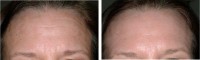 Wrinkle Reduction