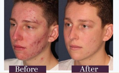Before and after acne treatment on a young man using Laser IPL - Catherine's Laser & Beauty Salon, Letterkenny, County Donegal, Ireland