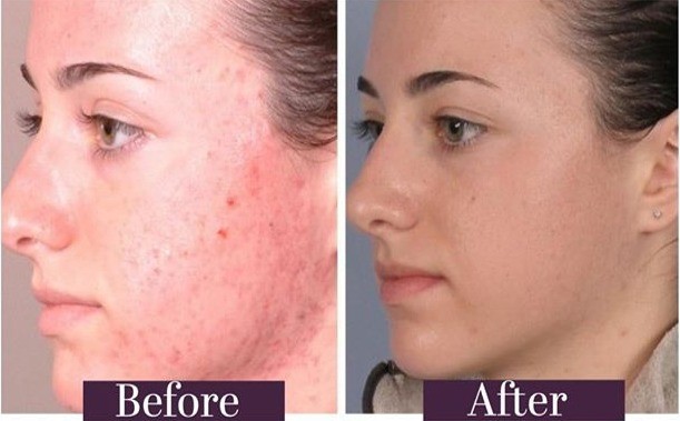 Before and after acne treatment on a young woman using Laser IPL - Catherine's Laser & Beauty Salon, Letterkenny, County Donegal, Ireland
