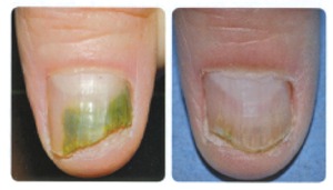 Before and after  Nd:YAG laser treatment of nail fungus. Catherine's Laser and Beauty Salon, Letterkenny Co. Donegal, Ireland