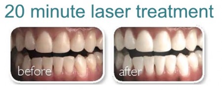 Before and after Teeth Whitening with the Megawhite Teeth Whitening system at Catherine's Laser & Beauty Salon, Donegal, Ireland