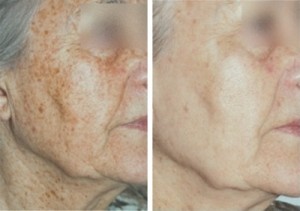 Remove sun and age spots, diffuse redness and uneven pigmentation on the face and body - Catherine's Laser & Beauty Salon, Letterkenny, Co. Donegal, Ireland
