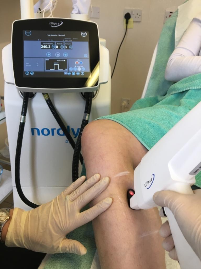 Leg vein treatment by Ellipse Nd:YAG laser - undertaken by Catherine's Laser and Beauty Salon, Letterkenny Co. Donegal, Ireland