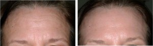 Wrinkles before and after treatment with Ellipse Laser IPL treatment . Catherine's Laser & Beauty Salon, Letterkenny, Co. Donegal, Ireland