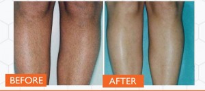 Before and after hair removal a man's legs. Laser IPL treatment by Catherine's Laser & Beauty Salon, Letterkenny, Co. Donegal, Ireland