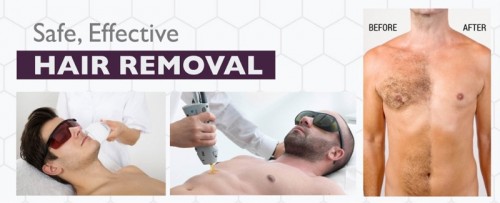 Hair removal for men by Catherine's Laser & Beauty Salon, Letterkenny, County Donegal, Ireland
