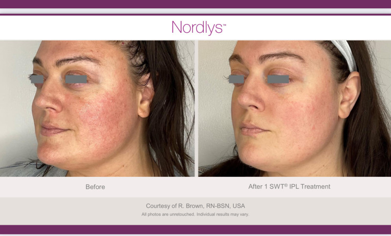 Rosacea before and after treatment with Laser IPL. Catherine's Laser & Beauty Salon, Letterkenny, Co. Donegal, Ireland