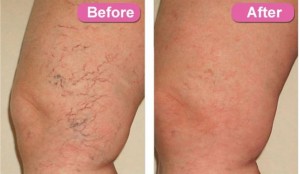 Before and after thread vein treatment with Laser IPL. Catherine's Laser & Beauty Salon, Letterkenny, Co. Donegal, Ireland