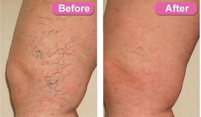 Before and after thread vein treatment with Laser IPL. Catherine's Laser & Beauty Salon, Letterkenny, Co. Donegal, Ireland