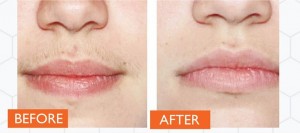 Before and after hair removal above a woman's lips. Laser IPL treatment by Catherine's Laser & Beauty Salon, Letterkenny, Co. Donegal, Ireland