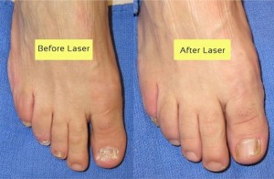 Before and after  Nd:YAG laser treatment of nail fungus. Catherine's Laser and Beauty Salon, Letterkenny Co. Donegal, Ireland