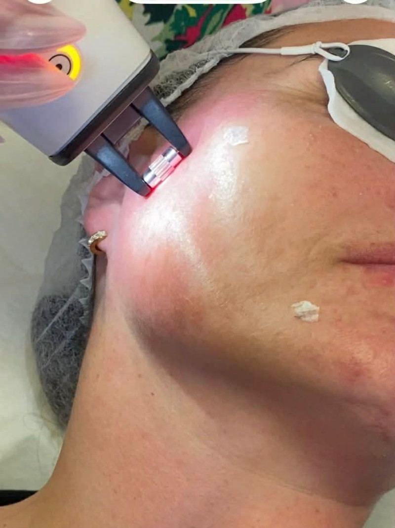 Non Ablative Fractional Laser treatment  stimulates natural healing - Catherine's Skin, Laser & Beauty Salon, Donegal, Ireland