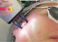 Non Ablative Fractional Laser