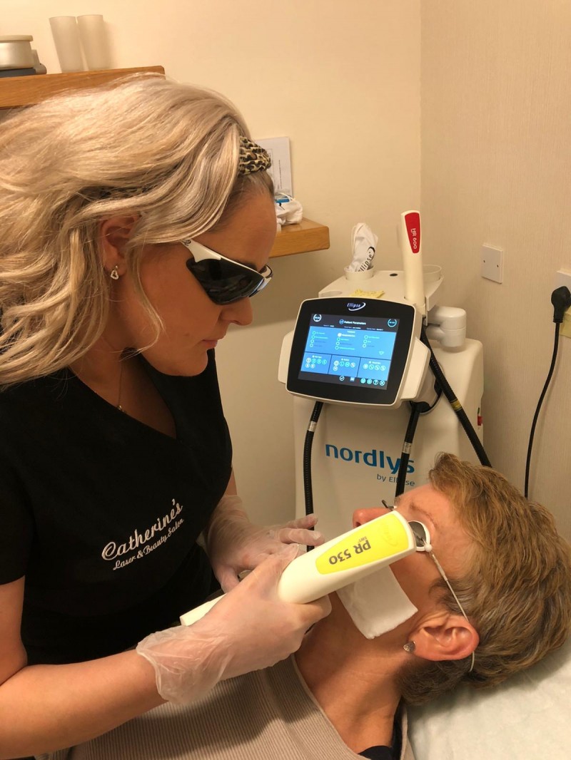 Laser photo rejuvenation for sun damaged skin, UV damage, age spots, Hyperpigmentation - Catherine's Laser & Beauty Salon, Letterkenny, County Donegal, Ireland