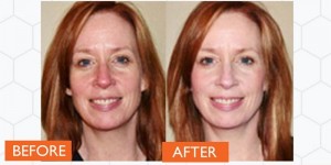 Rosacea before and after treatment with Laser IPL. Catherine's Laser & Beauty Salon, Letterkenny, Co. Donegal, Ireland