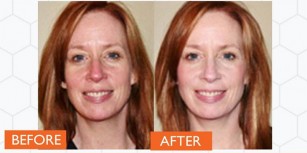 Rosacea before and after treatment with Laser IPL. Catherine's Laser & Beauty Salon, Letterkenny, Co. Donegal, Ireland